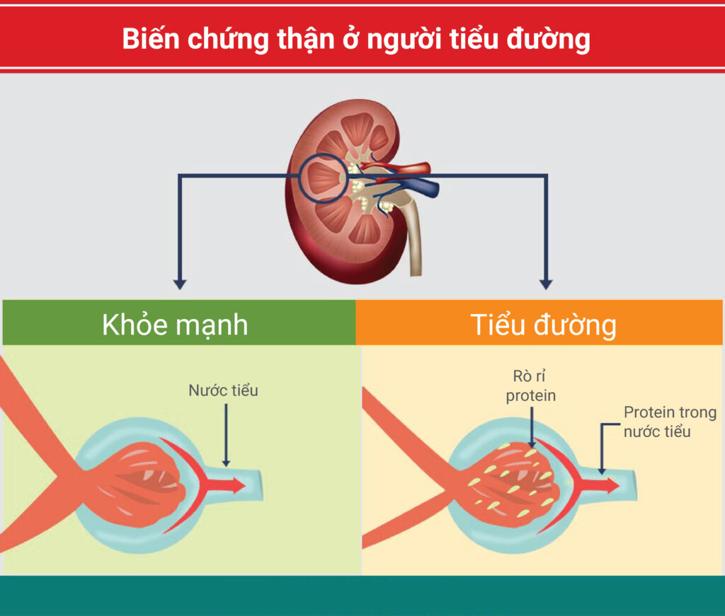 Tiểu đường gây các bệnh về mắt