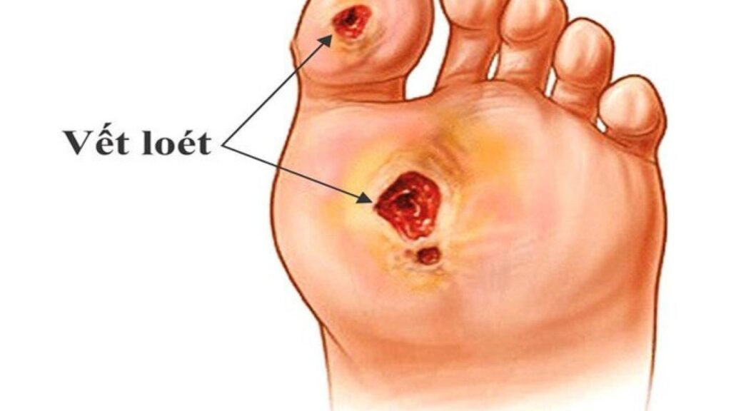 Tiểu đường gây ra các vấn đề về da